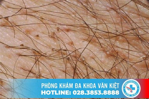 Bệnh rận mu ở nam giới là như thế nào? Bệnh rận mu ở nam giới là như thế nào?